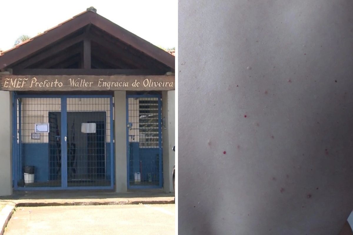 Sobe para 71 o número de alunos e funcionários afastados por suspeita de sarna em escola de Atibaia