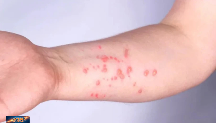 Mongaguá investiga dois casos suspeitos de mpox e pacientes aguardam resultado do Instituto Adolfo Lutz